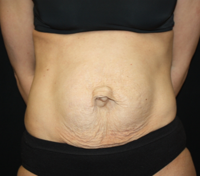 Tummy Tuck Before & After Patient #22917