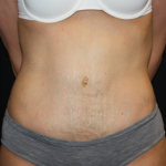 Tummy Tuck Before & After Patient #22917