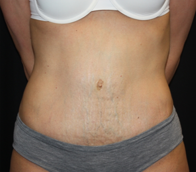 Tummy Tuck Before & After Patient #22917