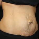 Tummy Tuck Before & After Patient #22917