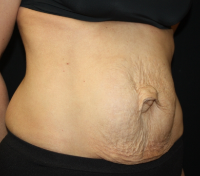 Tummy Tuck Before & After Patient #22917