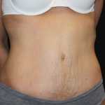 Tummy Tuck Before & After Patient #22917