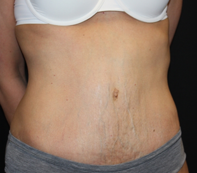 Tummy Tuck Before & After Patient #22917