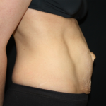 Tummy Tuck Before & After Patient #22917