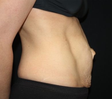 Tummy Tuck Before & After Patient #22917