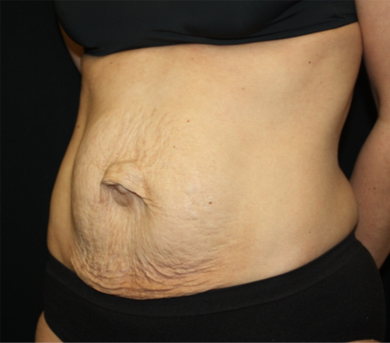 Tummy Tuck Before & After Patient #22917