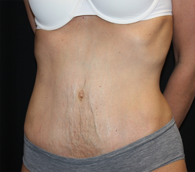 Tummy Tuck Before & After Patient #22917