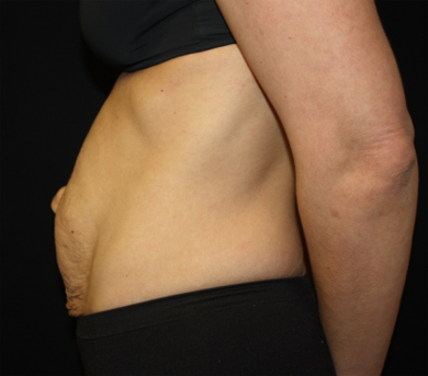 Tummy Tuck Before & After Patient #22917