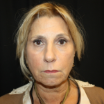 Facelift Before & After Patient #21136