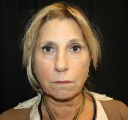 Facelift Before & After Patient #21136