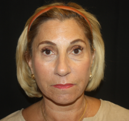 Facelift Before & After Patient #21136