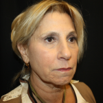 Facelift Before & After Patient #21136