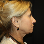 Facelift Before & After Patient #21136