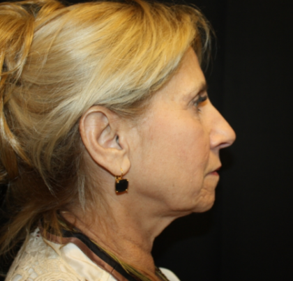 Facelift Before & After Patient #21136