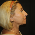 Facelift Before & After Patient #21136