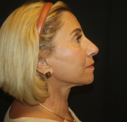 Facelift Before & After Patient #21136