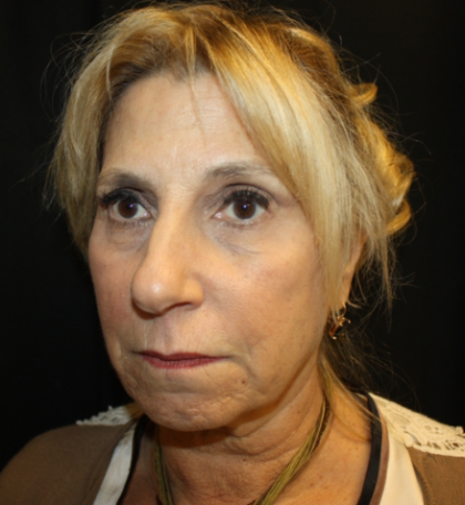 Facelift Before & After Patient #21136