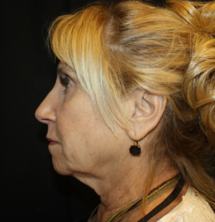 Facelift Before & After Patient #21136