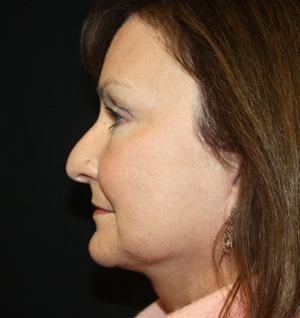 Facelift Before & After Patient #23479