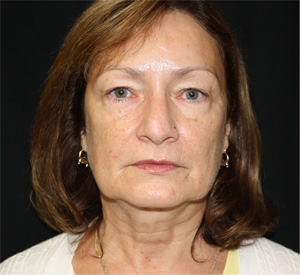 Facelift Before & After Patient #23479