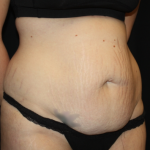 Tummy Tuck Before & After Patient #19896