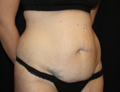Tummy Tuck Before & After Patient #19896