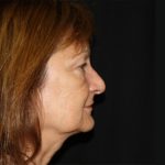 Facelift Before & After Patient #23479