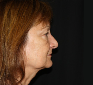 Facelift Before & After Patient #23479