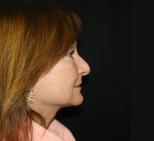 Facelift Before & After Patient #23479