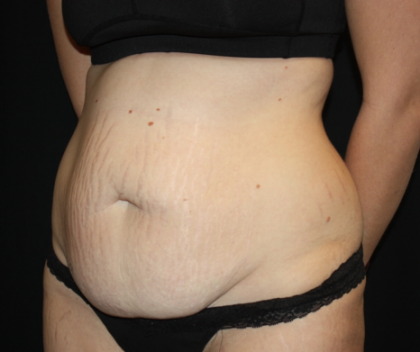 Tummy Tuck Before & After Patient #19896