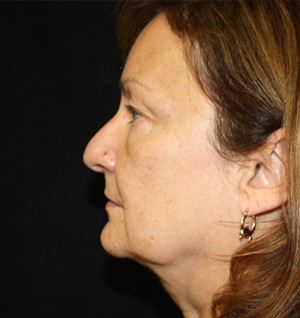 Facelift Before & After Patient #23479