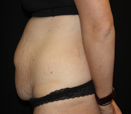 Tummy Tuck Before & After Patient #19896