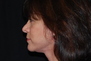 Facelift Before & After Patient #21185