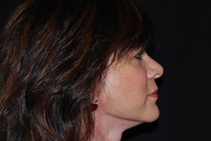 Facelift Before & After Patient #21185