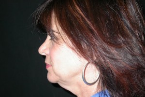 Facelift Before & After Patient #21185