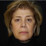 Facelift Before & After Patient #21202