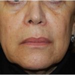 Facelift Before & After Patient #21202