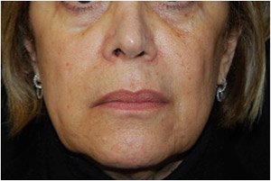 Facelift Before & After Patient #21202