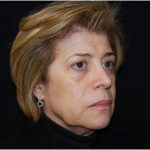 Facelift Before & After Patient #21202