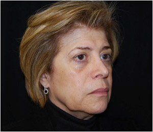 Facelift Before & After Patient #21202