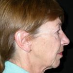 Facelift Before & After Patient #21203