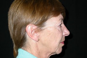 Facelift Before & After Patient #21203