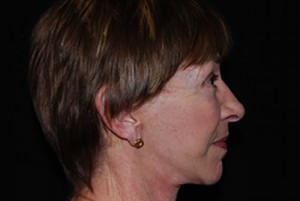 Facelift Before & After Patient #21203