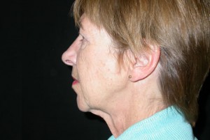 Facelift Before & After Patient #21203