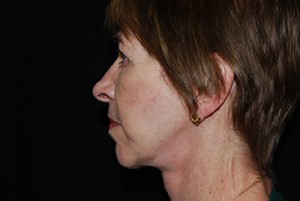 Facelift Before & After Patient #21203