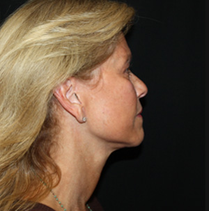 Facelift Before & After Patient #23508