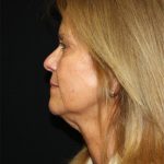 Facelift Before & After Patient #23508