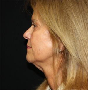 Facelift Before & After Patient #23508