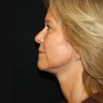 Facelift Before & After Patient #23508