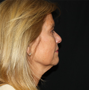 Facelift Before & After Patient #23508